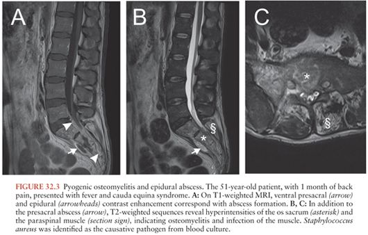 when to give mr contrast after lumbar surgery