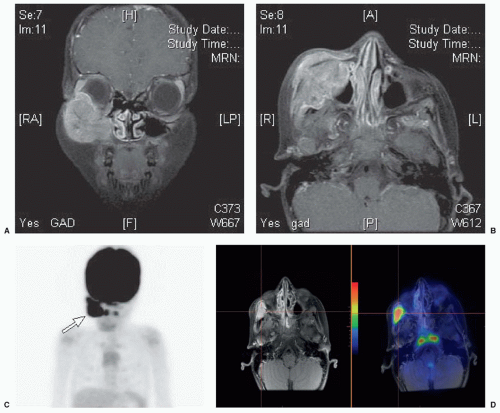 Rhabdomyosarcoma Oncohema Key 4298