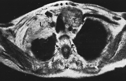 MAGNETIC RESONANCE IMAGING OF THE THYROID | Oncohema Key