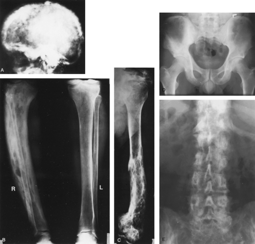 Paget Disease Of Bone Oncohema Key