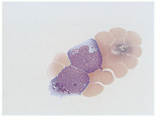 Pathology And Molecular Diagnosis Of Leukemias And Lymphomas | Oncohema Key