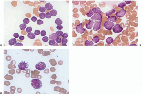 Pathology and Molecular Diagnosis of Leukemias and Lymphomas | Oncohema Key