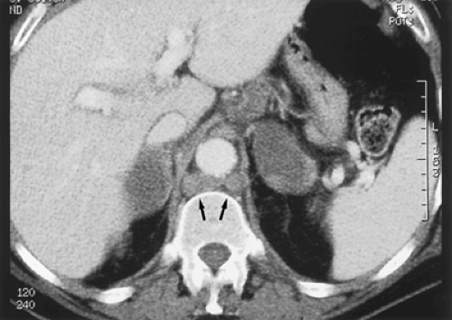 ADRENAL LESIONS WITH ENDOCRINE FUNCTION | Oncohema Key