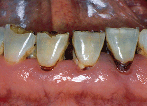 Xerostomia In Diabetes Mellitus Diabetes Care