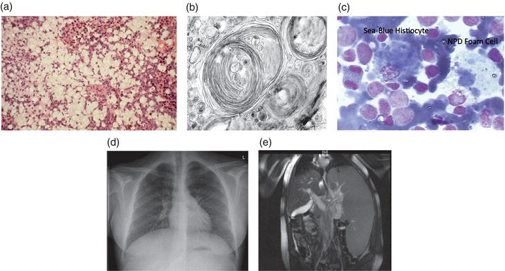 Niemann-Pick disease type-B: a unique case report with compound