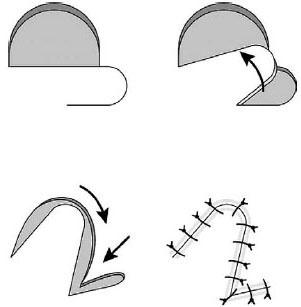 Local and Distant Pedicle Flaps for Soft Tissue Reconstruction of the ...