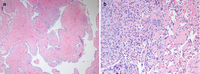 hereditary hemorrhagic telangiectasia histology