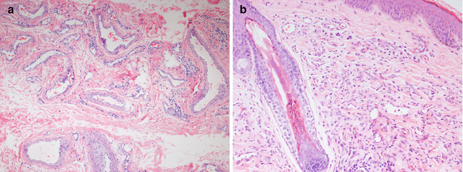 hereditary hemorrhagic telangiectasia histology