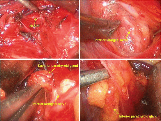 minimally invasive parathyroidectomy