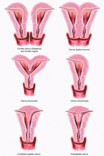 Low Complete Transverse Vaginal Septum, Vesico
