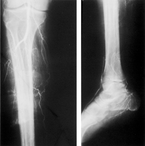 Icd Code For Bilateral Lower Extremity Edema