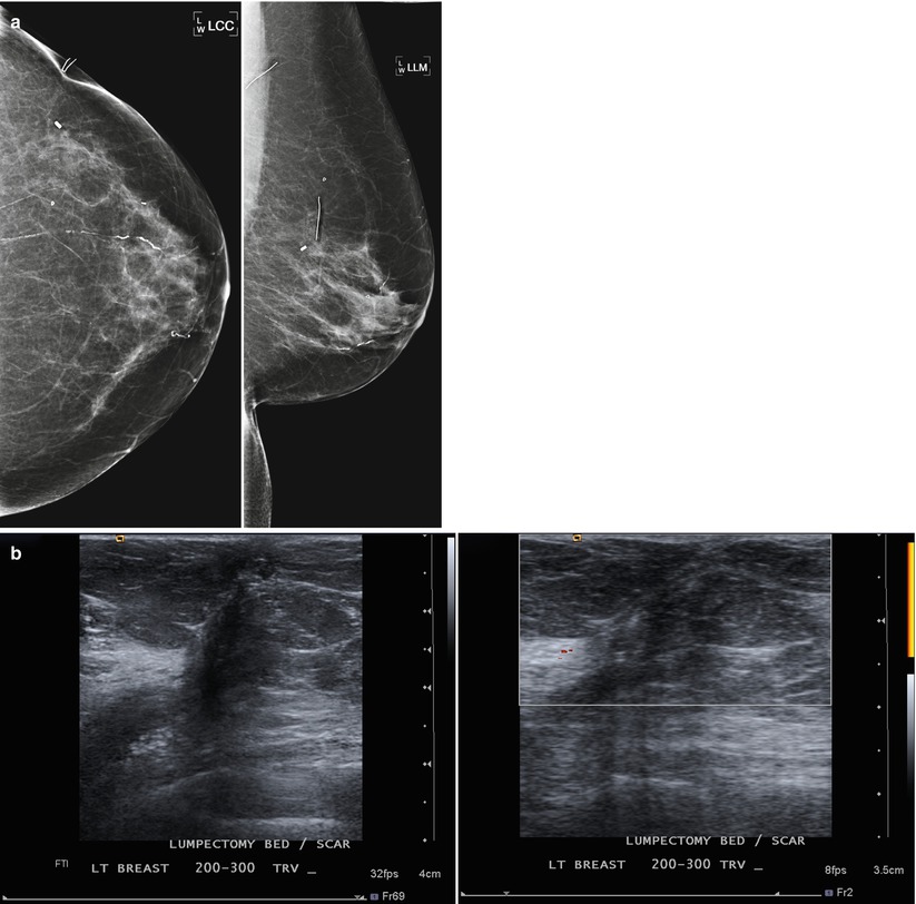 Post-operative image. Right breast 30 days after