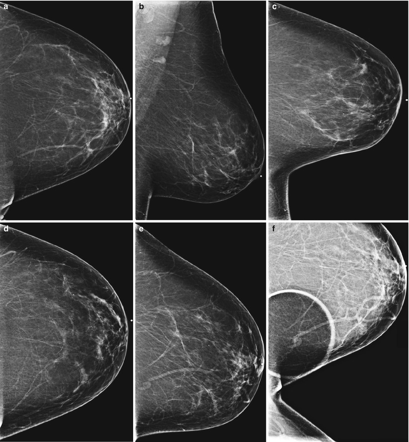 Breast Anatomy, as seen in the Wavelia OBCD scanner: Side view