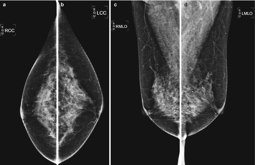 Comparison of the breast mass with the craniocaudal (CC) and