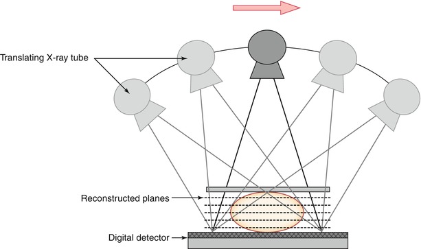 Study of role of digital breast tomosynthesis over digital