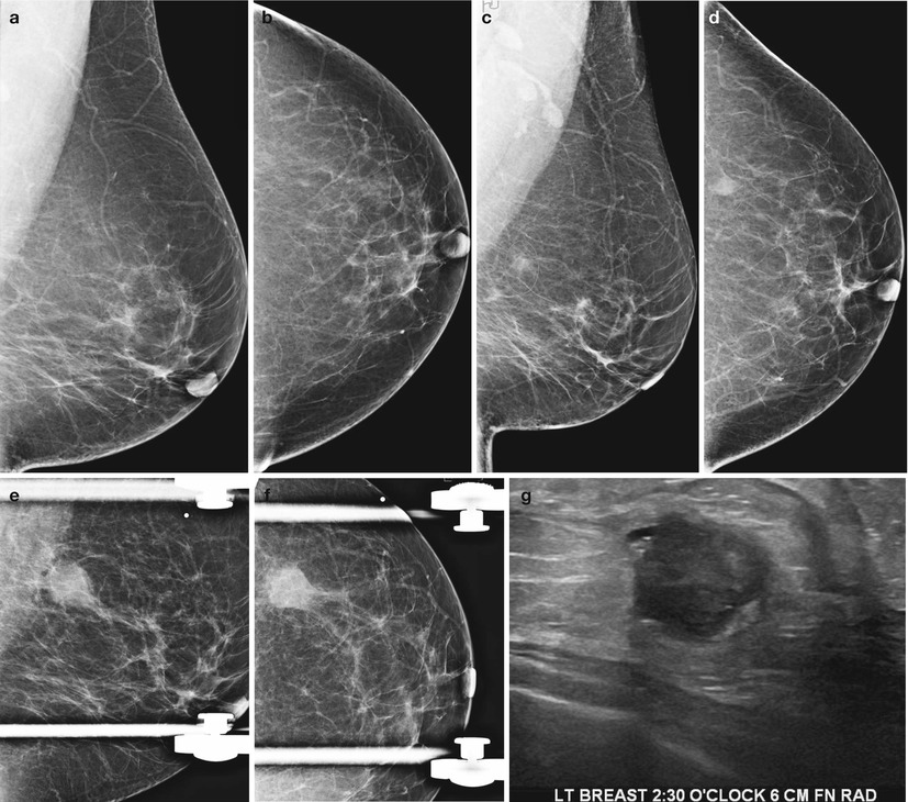 Case 4; Mammography of right breast lesions (pointed by arrows)