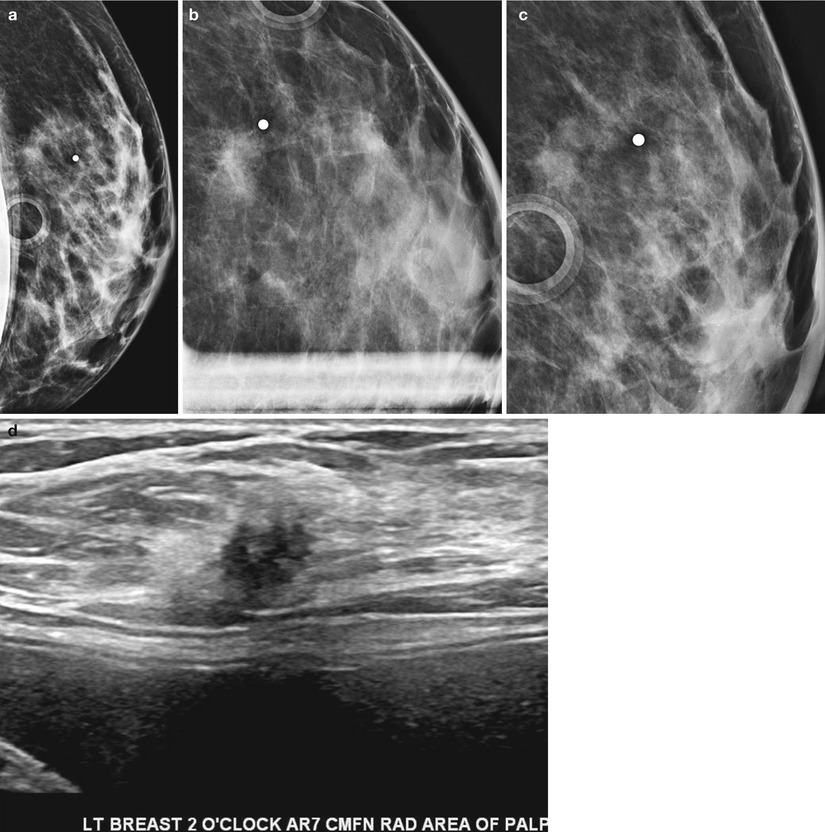 Breast Asymmetry and Calcification: Causes, Symptoms, Treatment –  Symmetrista