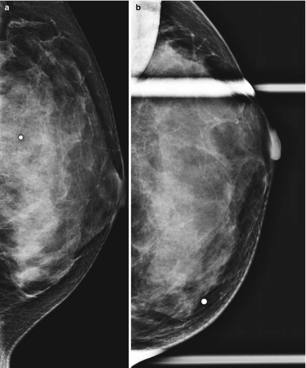Breast Asymmetry and Calcification: Causes, Symptoms, Treatment –  Symmetrista