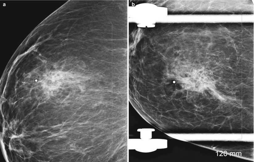 Breast Asymmetry and Calcification: Causes, Symptoms, Treatment –  Symmetrista