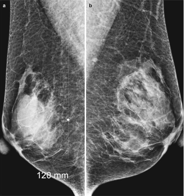 The breast  Radiology Key