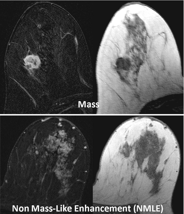 Breast MRI For Diagnosis And Staging Of Breast Cancer Oncohema Key