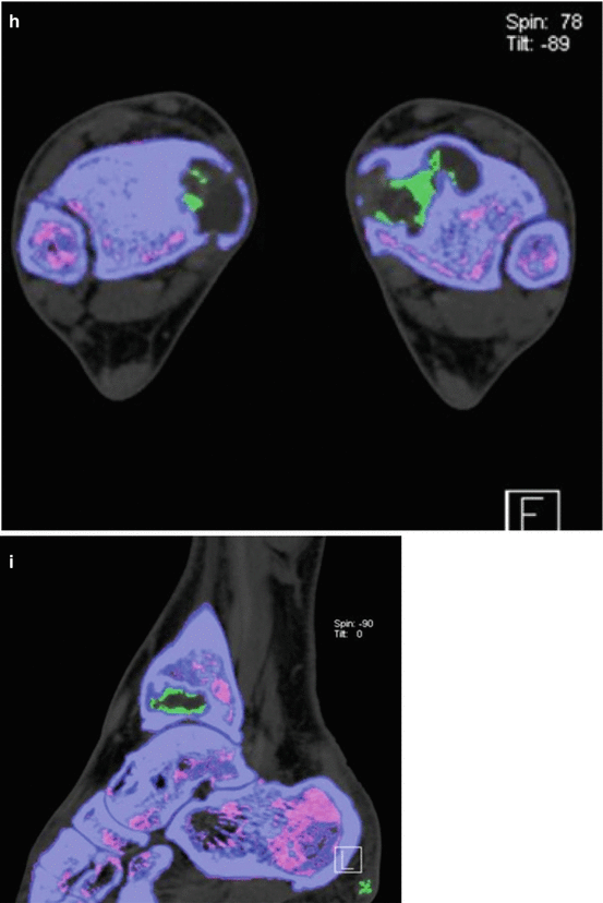 Dual Energy Ct In Musculoskeletal Tumors Oncohema Key