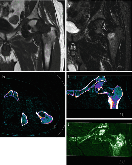 Dual Energy Ct In Musculoskeletal Tumors Oncohema Key