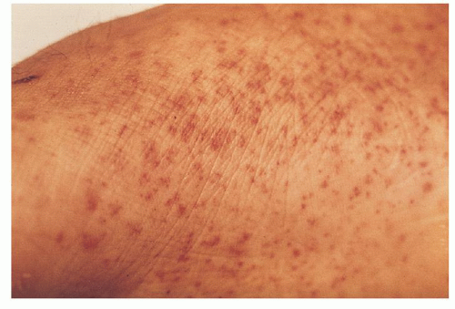 platelet disorders pinpoint rash