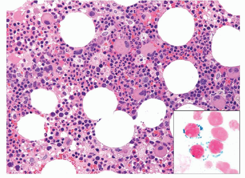 Pathology Of The Myeloproliferative Neoplasms | Oncohema Key