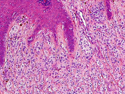 Balloon Cell Nevi and Balloon Cell Melanomas: What Are They? | Oncohema Key