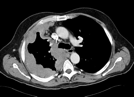 is stage 4 sarcoma curable