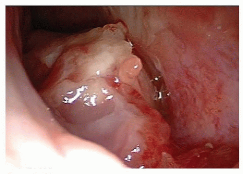 nasal cavity cancer