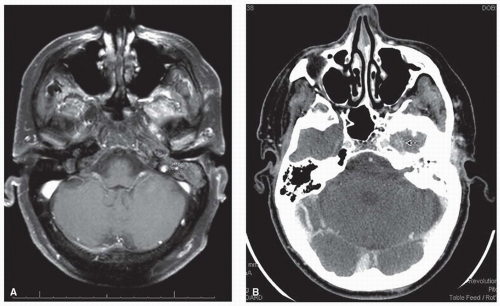 Ear and Temporal Bone Cancer | Oncohema Key