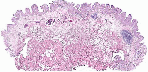 papillary urothelial proliferation of uncertain malignant potential