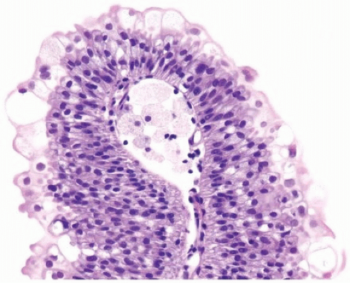 papillary urothelial hyperplasia icd 10)