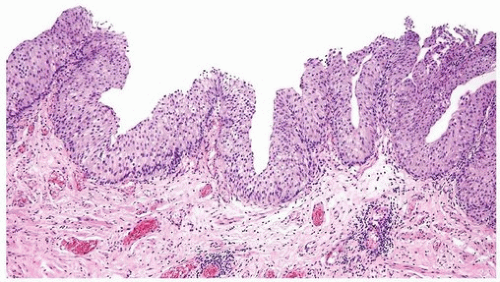 atypical papillary urothelial hyperplasia