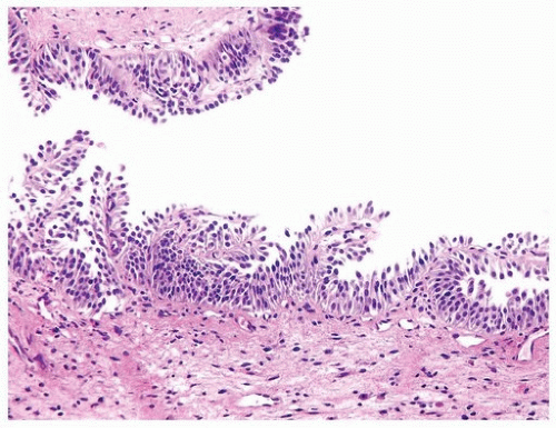 benign papillary urothelial schistosomiasis pre sinusoidal