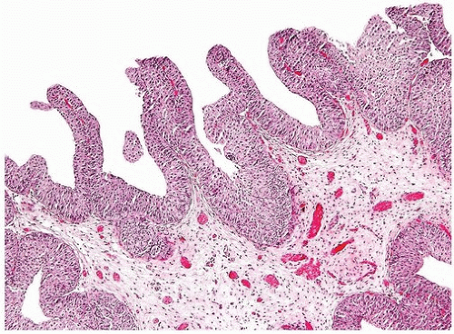 Papillary urothelial hyperplasia pathology - Veruci genitale solkovagin