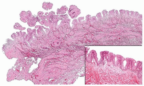 Papillary urothelial hyperplasia pathology outlines