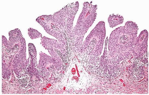papillary urothelial hyperplasia histology