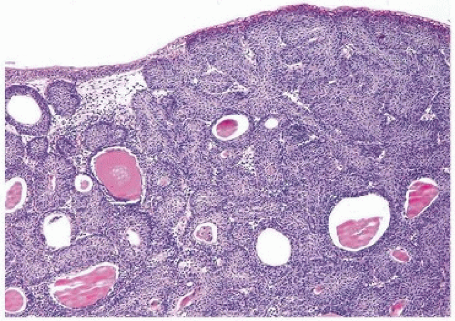 Inverted papilloma of bladder Inverted urothelial papilloma pathology