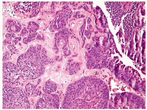 invasive-urothelial-carcinoma-oncohema-key