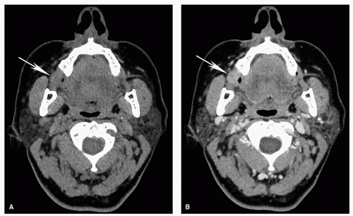 Imaging Of Head And Neck Cancer Oncohema Key