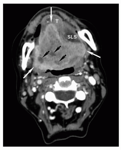 Imaging of Head and Neck Cancer | Oncohema Key