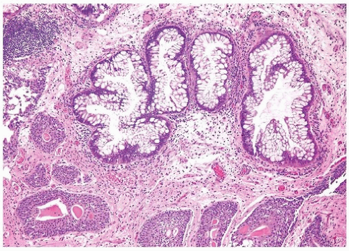 Glandular Lesions Oncohema Key 8620