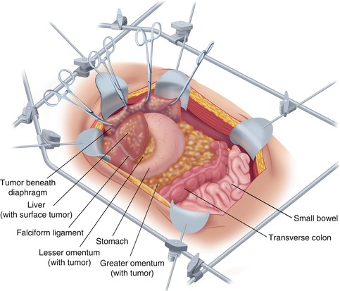 malignant mesothelioma grading