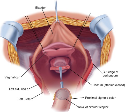 Vaginal Reconstruction With Sigmoid Colon In Vaginal Agenesis