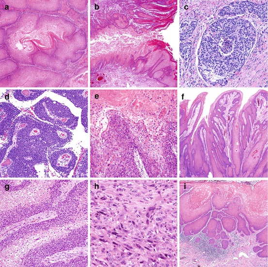 Pathology, Risk Factors, and HPV in Penile Squamous Cell Carcinoma ...