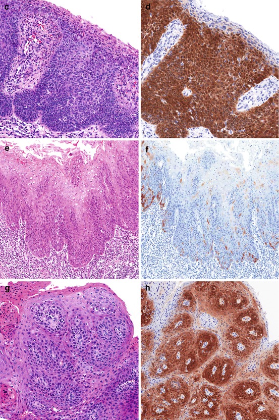 Pathology, Risk Factors, And HPV In Penile Squamous Cell Carcinoma ...