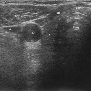 Thyroid Imaging | Oncohema Key